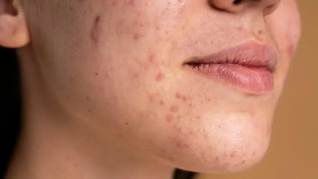 Acne Header